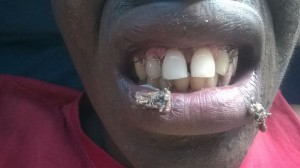 Aondofa showing level of injuries on his teeth an d  jaw