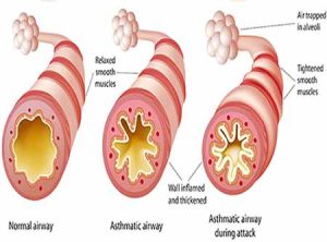 asthmatic-airway-shutterstock