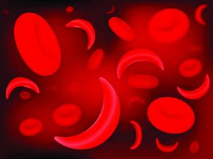 Sickle-cell and normal red blood cells