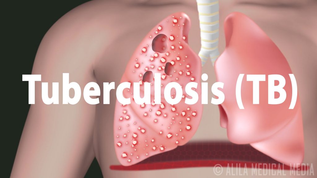 tuberculosis