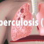 tuberculosis