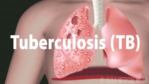 tuberculosis