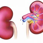 kidney disease