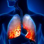 _pneumonia_lung_infection_800x600
