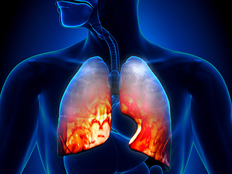 _pneumonia_lung_infection_800x600