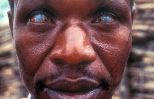River_blindness1