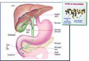 gall stones