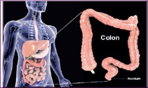 COLO CANCER