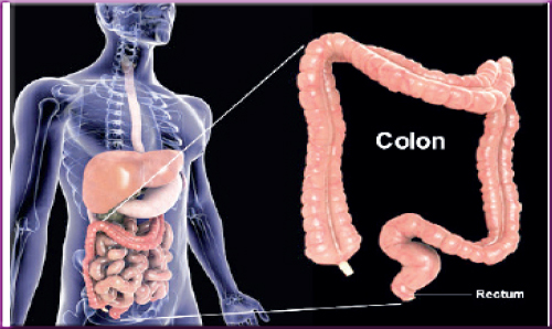 COLO CANCER