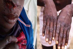 Monkey Pox
