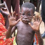 MONKEYPOX
