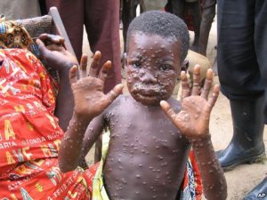 MONKEYPOX