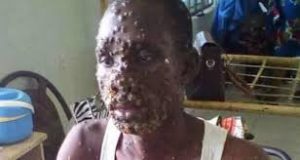 mokeypox