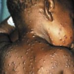 monkey pox