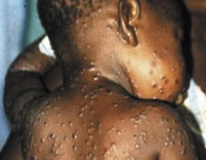 monkey pox