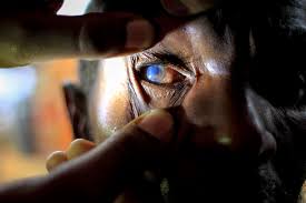 cataract