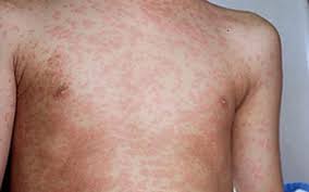 measles