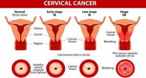 cervical-cancer-stages