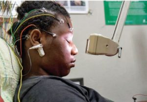 epilepsy-560×390