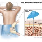 Bone-marrow-transplant-300×240