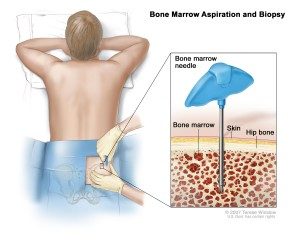 Bone-marrow-transplant-300×240