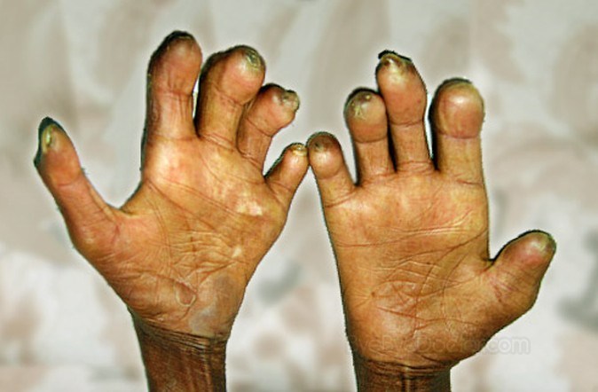 Leprosy-in-Nigeria