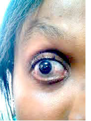 Eyes