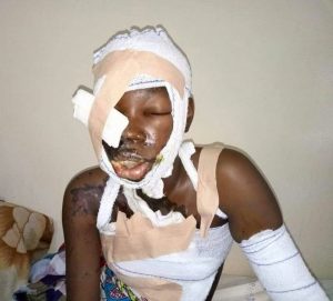 Unimaid-Acid-Victim-Fatima-Habu-Usman