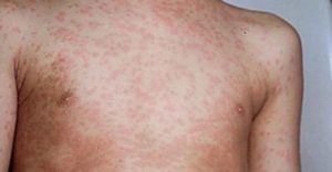 measles