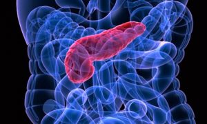 ACUTE PANCREATIS
