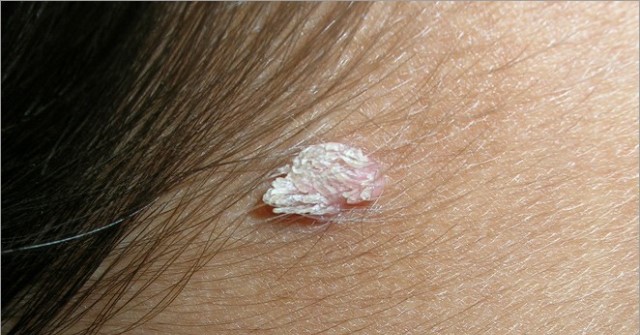 Skin-cancer