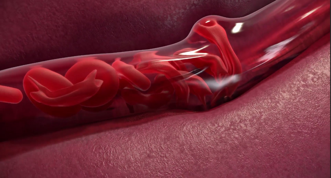 sickle