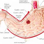 stomach ulcer