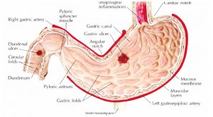 stomach ulcer