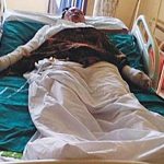 Kerosene explosion-victim