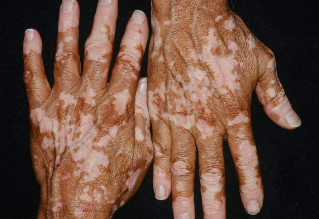 vitiligo-skin