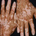 vitiligo-skin