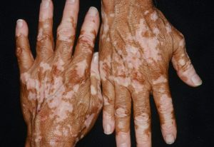 vitiligo-skin
