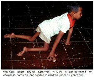Acute-Flaccid-Paralysis1