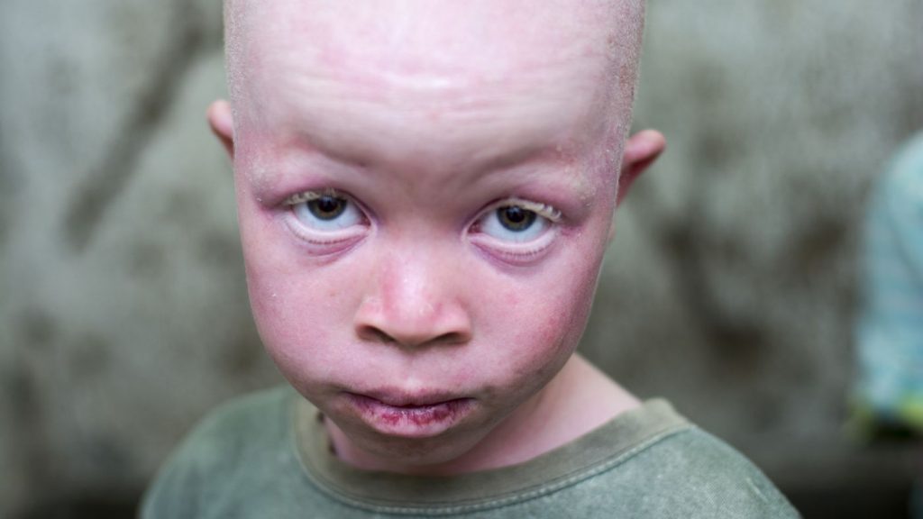 albino boy