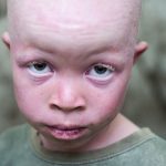 albino boy
