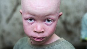 albino boy