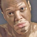 Vitiligo