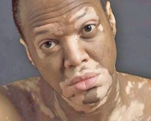 Vitiligo