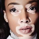 living with vitiligo