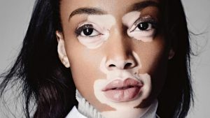living with vitiligo