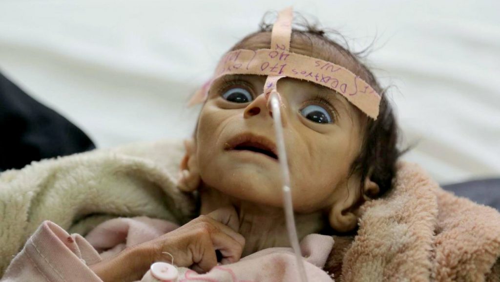 starving-baby-yemen