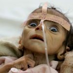 starving-baby-yemen