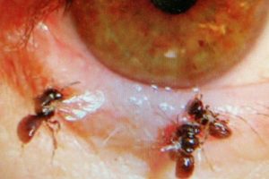 the-bees-found-in-the-Taiwanese-womans-eye-e1554966177511