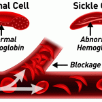 Sickle-Cell